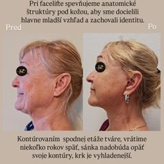 Facelift a Necklift MUDr. Ján Zeleňák