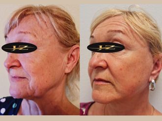 Facelift pred a po - 875646