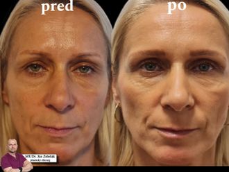 Blefaroplastika pred a po - 876165