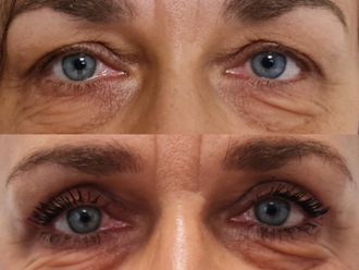 Blefaroplastika pred a po - 876169