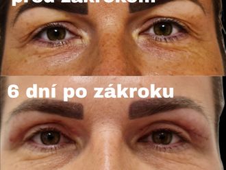 Blefaroplastika pred a po - 876687