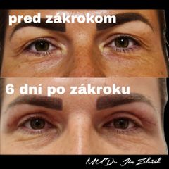 Horné viečka 6 dní po
