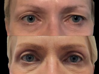 Blefaroplastika pred a po - 876688