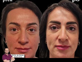 Blefaroplastika pred a po - 876689