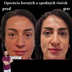Horné a dolné viečka MUDr. Ján Zeleňák