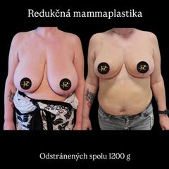 Redukčná mammaplastika