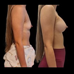 Augmentácia z pazúch 345 ml
