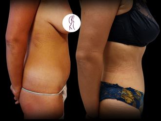 Abdominoplastika pred a po - 877444