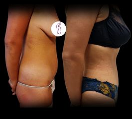 Abdominoplastika MUDr. Ján Zeleňák