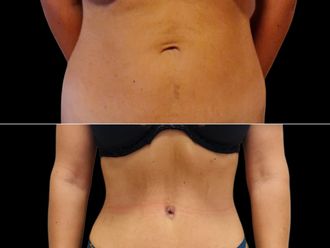 Abdominoplastika pred a po - 877445