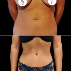 MUDr. Ján Zeleňák Abdominoplastika