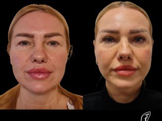 Facelift pred a po - 878232