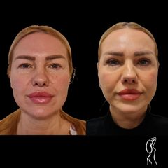 Facelift a Necklift