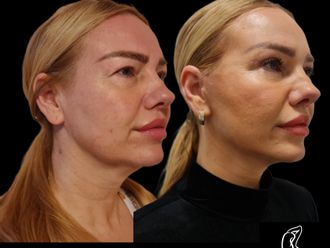 Facelift pred a po - 878233