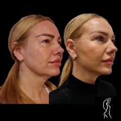 Facelift a Necklift