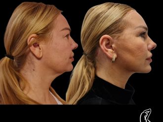 Facelift pred a po - 878234