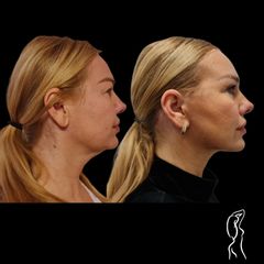 Facelift a Necklift