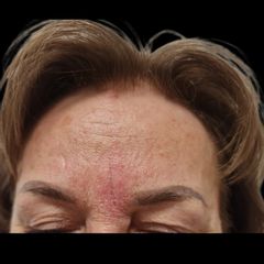 Korekcia vrasky hnevu kyselinou hyaluronovou