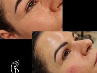 Kyselina hyalurónová pred a po - 878328