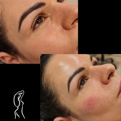 Vyplň kruhov pod očami kyselinou hyalurónovou