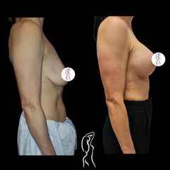 Augmentácia s modeláciou