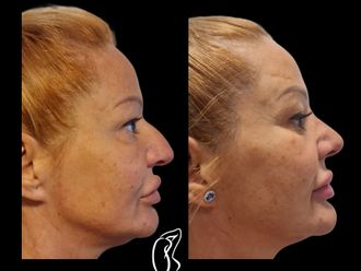 Rhinoplastika pred a po - 879661