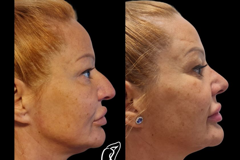 Rhinoplastika pred a po - 879661