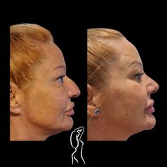Rinoplastika