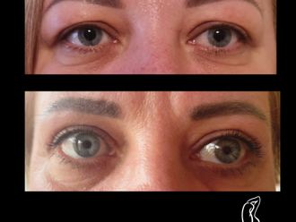 Blefaroplastika pred a po - 879754