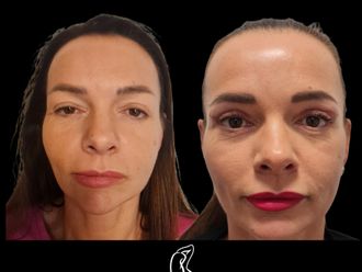 Blefaroplastika pred a po - 879755