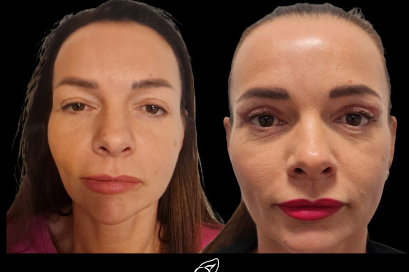 Blefaroplastika pred a po - 879755