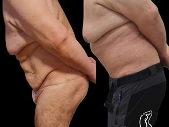 Abdominoplastika pred a po - 879849