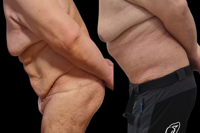 Abdominoplastika pred a po - 879849
