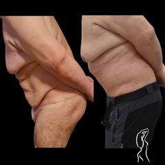 Abdominoplastika