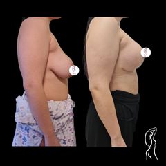 Augmentácia a modelácia