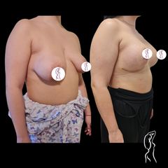 Augmentácia a modelácia