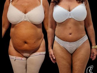 Abdominoplastika pred a po - 880261
