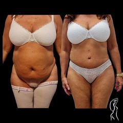 ABDOMINOPLASTIKA MUDr. Ján Zeleňák