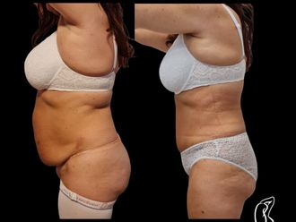 Abdominoplastika pred a po - 880262