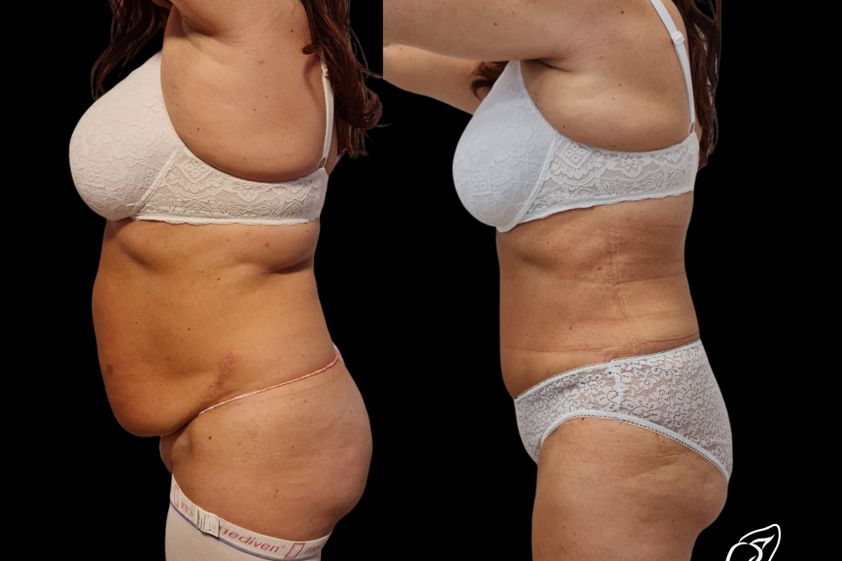 Abdominoplastika pred a po - 880262