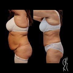 ABDOMINOPLASTIKA MUDr. Ján Zeleňák