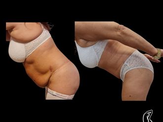 Abdominoplastika pred a po - 880263