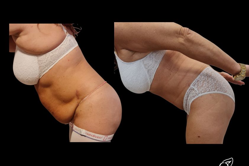 Abdominoplastika pred a po - 880263