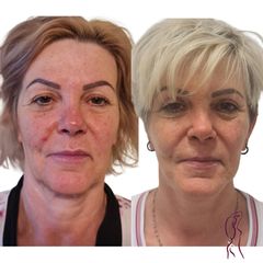 Facelift a Necklift - MUDr. Ján Zeleňák