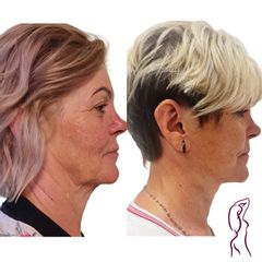 Facelift a Necklift - MUDr. Ján Zeleňák