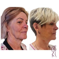 Facelift a Necklift - MUDr. Ján Zeleňák