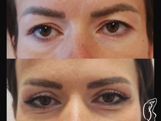 Blefaroplastika pred a po - 881323