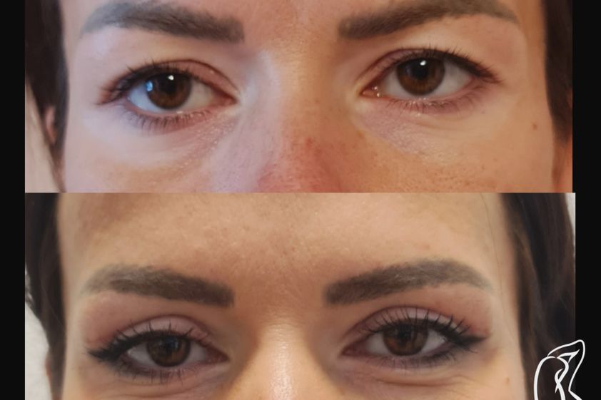 Blefaroplastika pred a po - 881323