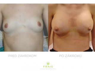 Zväčšenie prsníkov implantátmi Motiva Ergonomics (360 ml)