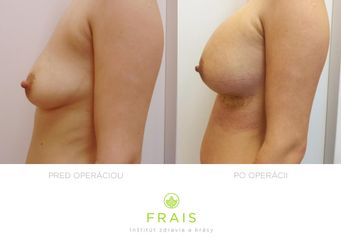 Zväčšenie poprsia implantátmi Motiva